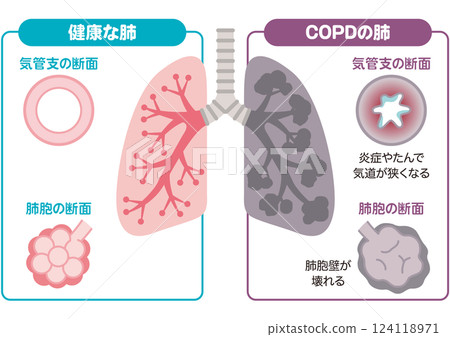 健康和慢性阻塞性肺病 124118971