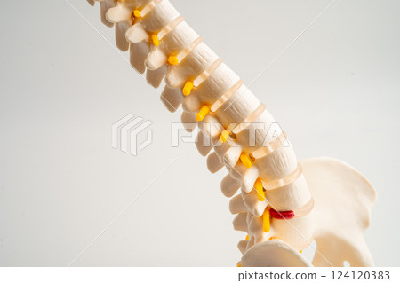 Lumbar spine displaced herniated disc fragment, spinal nerve and bone. Model for treatment medical in the orthopedic department. 124120383