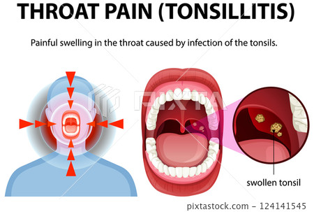 Understanding Throat Pain and Tonsillitis 124141545