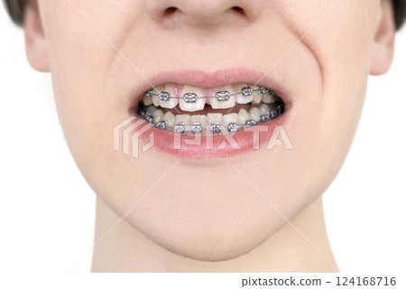 Crooked growing teeth after visiting the dentist and installing braces Crooked growing teeth after visiting the dentist and installing braces 124168716