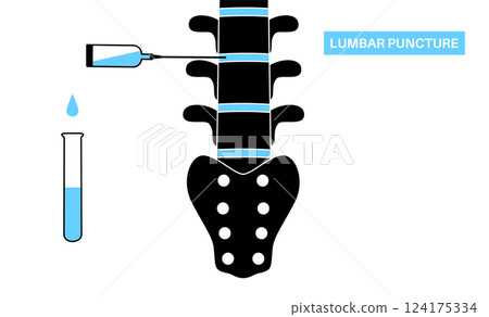 Lumbar puncture spinal tap 124175334