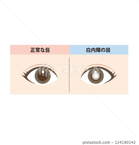 Illustration of a comparison between a normal eye and an eye with cataracts 124180142