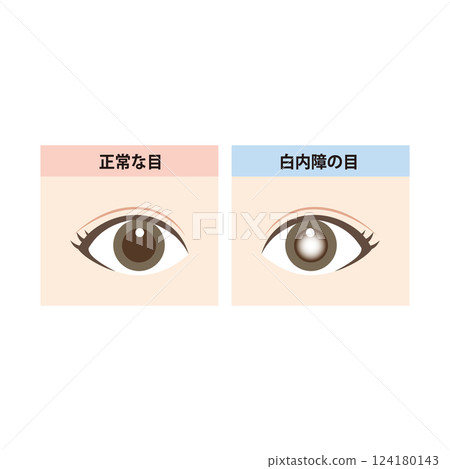 Illustration of a comparison between a normal eye and an eye with cataracts Illustration of a comparison between a normal eye and an eye with cataracts 124180143