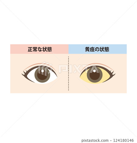 正常眼睛與眼白黃疸眼睛的比較圖 正常眼睛與眼白黃疸眼睛的比較圖 124180146