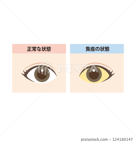 正常眼睛與眼白黃疸眼睛的比較圖 正常眼睛與眼白黃疸眼睛的比較圖 124180147