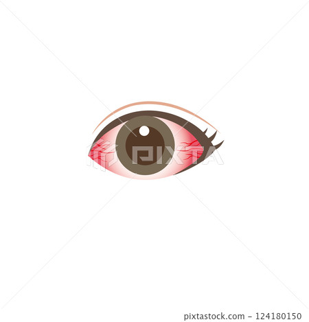 Eyes that are severely bloodshot due to conjunctivitis, etc. Eyes that are severely bloodshot due to conjunctivitis, etc. 124180150