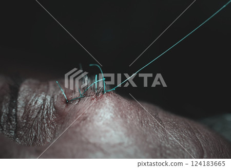 Surgical stitch in forehead Surgical stitch in forehead 124183665