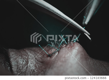 Surgical stitch in forehead 124183666