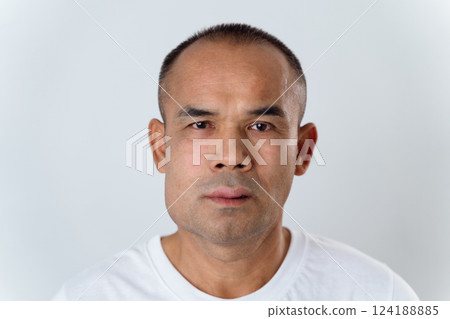 The man has facial swelling due to an allergic reaction to triggers such as insect bites stings. 124188885
