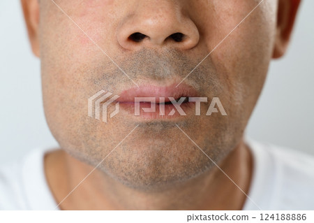 The man has facial swelling due to an allergic reaction to triggers such as insect bites stings. The man has facial swelling due to an allergic reaction to triggers such as insect bites stings. 124188886