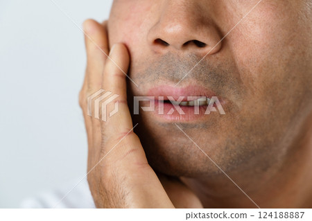 The man has facial swelling due to an allergic reaction to triggers such as insect bites stings. The man has facial swelling due to an allergic reaction to triggers such as insect bites stings. 124188887