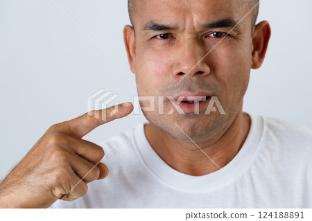 The man has facial swelling due to an allergic reaction to triggers such as insect bites stings. 124188891