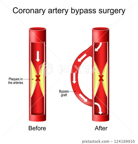 Coronary artery bypass graft. Heart surgery Coronary artery bypass graft. Heart surgery 124189910