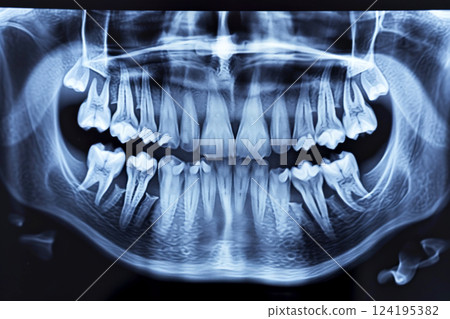 panoramic x-ray photo of teeth. ai generative 124195382