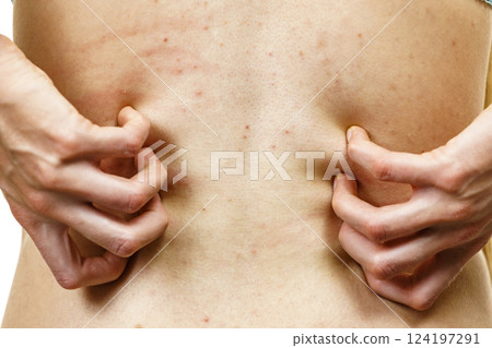 Woman scratching her itchy back with allergy rash 124197291