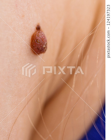 Closeup brown mole on caucasian woman skin. Closeup brown mole on caucasian woman skin. 124197323