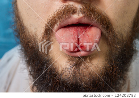 tongue splitting. cutting the tongue, one type of modification of the human body. surgery concept. 124208788