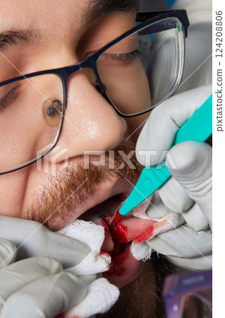 tongue splitting. cutting the tongue, one type of modification of the human body. surgery concept. 124208806