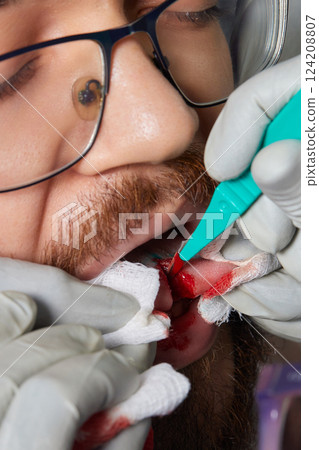 tongue splitting. cutting the tongue, one type of modification of the human body. surgery concept. 124208807