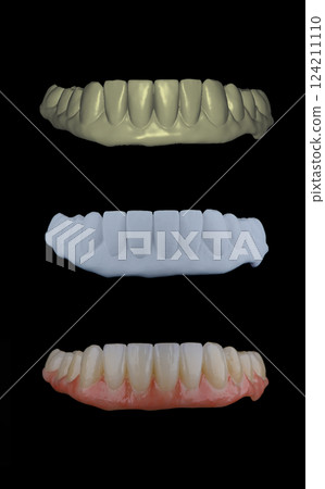 Three stages of making full dental zirkonium prosthesis on titabium bar. Dental care concept. 124211110