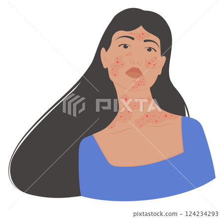 Woman with demodicosis, psoriasis skin disease. Rosacea Awareness Month illustration Woman with demodicosis, psoriasis skin disease. Rosacea Awareness Month illustration 124234293