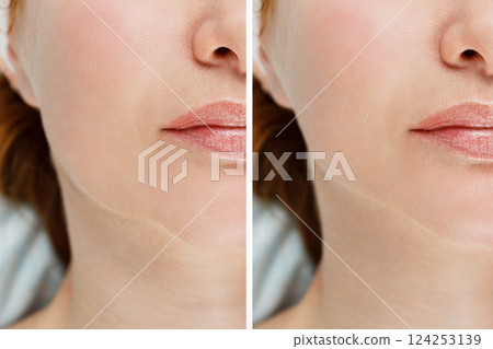 Female double chin before and after correction. Result of procedure in the clinic of aesthetic medicine. 124253139