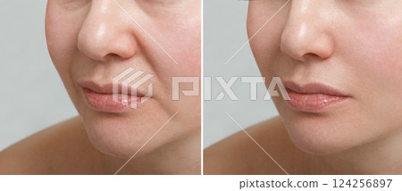 Female nasolabial fold before and after wrinkle smoothing procedures. Correction of the chin and neck shape. The result of the rejuvenation procedure at the aesthetic medicine clinic. 124256897