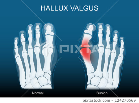 Bunion. Hallux valgus. Foot deformity 124270569