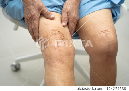 Asian elderly woman patient with scar knee replacement surgery in hospital. Asian elderly woman patient with scar knee replacement surgery in hospital. 124274588