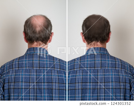 Human hair loss solution concept 124301352