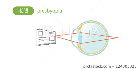 Illustration of the structure of presbyopia for seeing near objects Illustration of the structure of presbyopia for seeing near objects 124303323