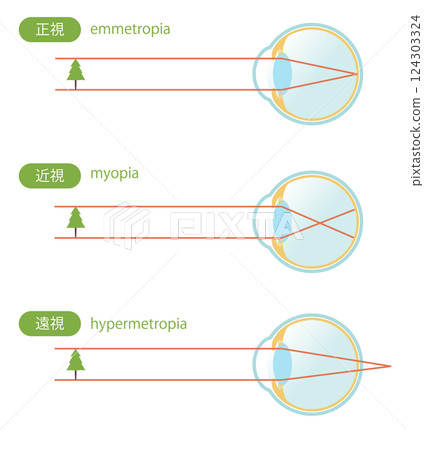 Illustration set of normal eye, myopic eye, and hyperopic eye 124303324