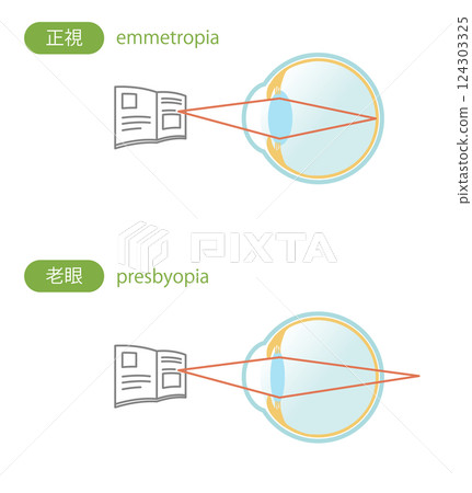 Illustration set of normal and presbyopic eyes Illustration set of normal and presbyopic eyes 124303325