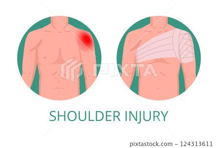 Shoulder injury medical treatment. Human body part first aid infographic, injured shoulder torso part first aid methods flat vector illustration. Cartoon medical bandaging Shoulder injury medical treatment. Human body part first aid infographic, injured shoulder torso part first aid methods flat vector illustration. Cartoon medical bandaging 124313611