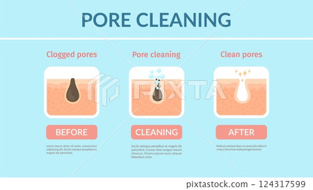 Skin pore cleaning, vector face care, blackhead acne treatment, beauty and dermatology medicine. Clogged face skin cleaning process diagram with before and after pore cleaning treatment steps Skin pore cleaning, vector face care, blackhead acne treatment, beauty and dermatology medicine. Clogged face skin cleaning process diagram with before and after pore cleaning treatment steps 124317599