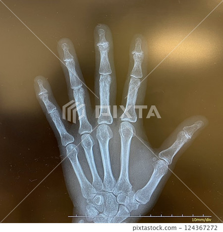 X-ray photo of hand X-ray photo of hand 124367272