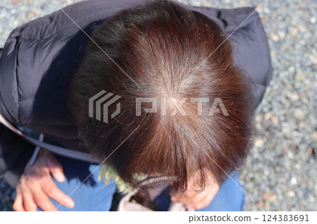 頭髮稀疏治療的女性 124383691