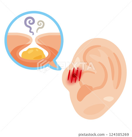 Illustration of an inflamed ear fistula 124385269