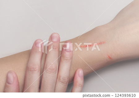 Scratches on the woman's hand. Scratches from cat, dog, falls close up photo White background 124393610
