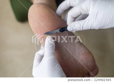 Medical procedure of scraping the skin of the foot for laboratory analysis and diagnosis of fungal infections. A doctor in sterile gloves takes a tissue sample using a scalpel and a slide Medical procedure of scraping the skin of the foot for laboratory analysis and diagnosis of fungal infections. A doctor in sterile gloves takes a tissue sample using a scalpel and a slide 124402565