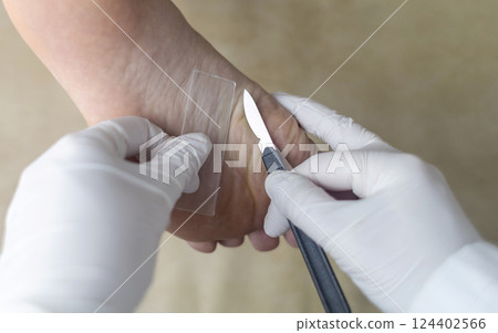 Medical procedure of scraping the skin of the foot for laboratory analysis and diagnosis of fungal infections. A doctor in sterile gloves takes a tissue sample using a scalpel and a slide Medical procedure of scraping the skin of the foot for laboratory analysis and diagnosis of fungal infections. A doctor in sterile gloves takes a tissue sample using a scalpel and a slide 124402566