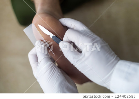 Medical procedure of scraping the skin of the foot for laboratory analysis and diagnosis of fungal infections. A doctor in sterile gloves takes a tissue sample using a scalpel and a slide Medical procedure of scraping the skin of the foot for laboratory analysis and diagnosis of fungal infections. A doctor in sterile gloves takes a tissue sample using a scalpel and a slide 124402585
