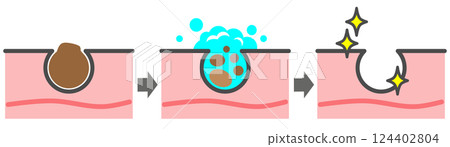 清潔肌膚、清除毛孔中的黑頭、獲得美麗肌膚的插圖 124402804