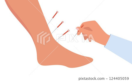 Acupuncture Therapy in Spa Salon. Hand Injects Needles in human foot. Chinese needle alternative medicine and treatment. Vector Illustration. 124405059