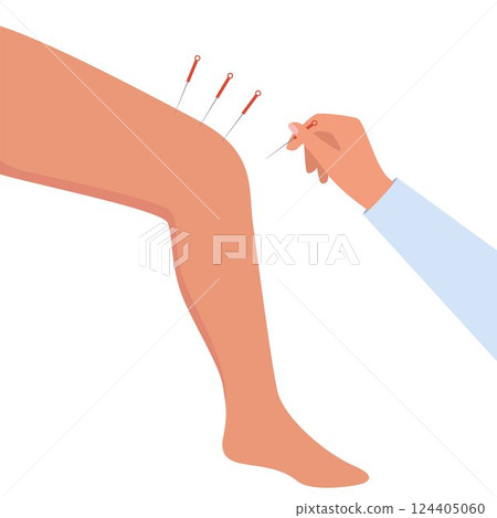 Acupuncture Therapy in Spa Salon. Hand Injects Needles in human leg. Chinese needle alternative medicine and treatment. Vector Illustration. Acupuncture Therapy in Spa Salon. Hand Injects Needles in human leg. Chinese needle alternative medicine and treatment. Vector Illustration. 124405060