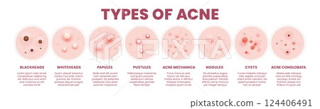 Body skin acne type pore inflammation infographics. Blackheads, whiteheads, papule, pustule, cyst and nodules, acne mechanica or acne conglobata. Skin disease caused by excess oil production, bacteria 124406491