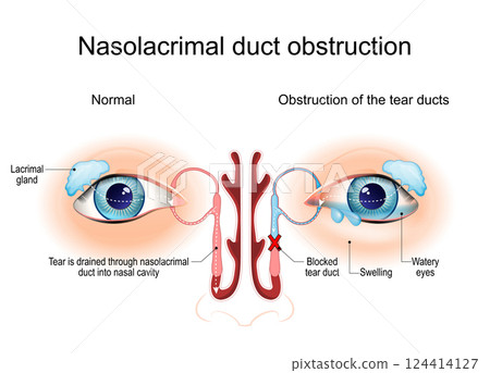 Nasolacrimal duct obstruction. Dacryocystitis. Cross section of Tear ducts Nasolacrimal duct obstruction. Dacryocystitis. Cross section of Tear ducts 124414127
