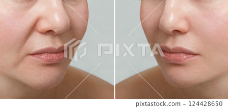 Female nasolabial fold before and after wrinkle smoothing procedures. Correction of the chin and neck shape. The result of the rejuvenation procedure at the aesthetic medicine clinic. 124428650