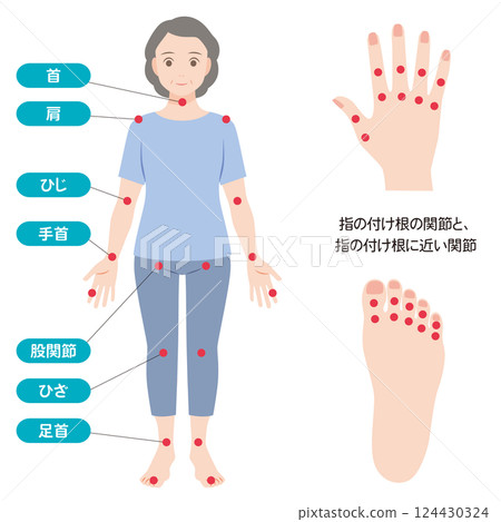 類風濕性關節炎症狀出現的主要關節 類風濕性關節炎症狀出現的主要關節 124430324