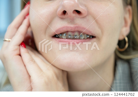 Woman smiling with braces on her teeth.  124441702